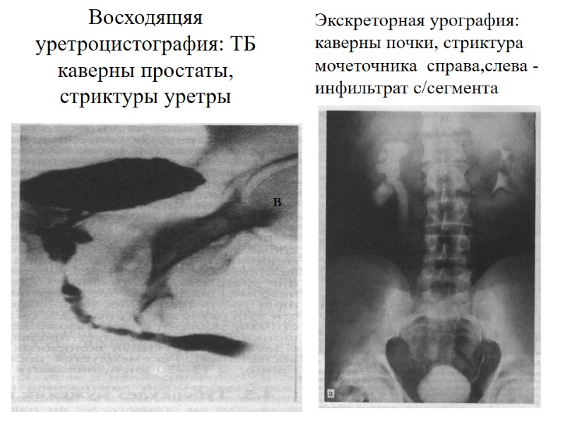 Экскреторная урография: каверны почки, стриктура мочеточника  справа,слева - инфильтрат с/сегмента в Восходящяя уретроцистография: